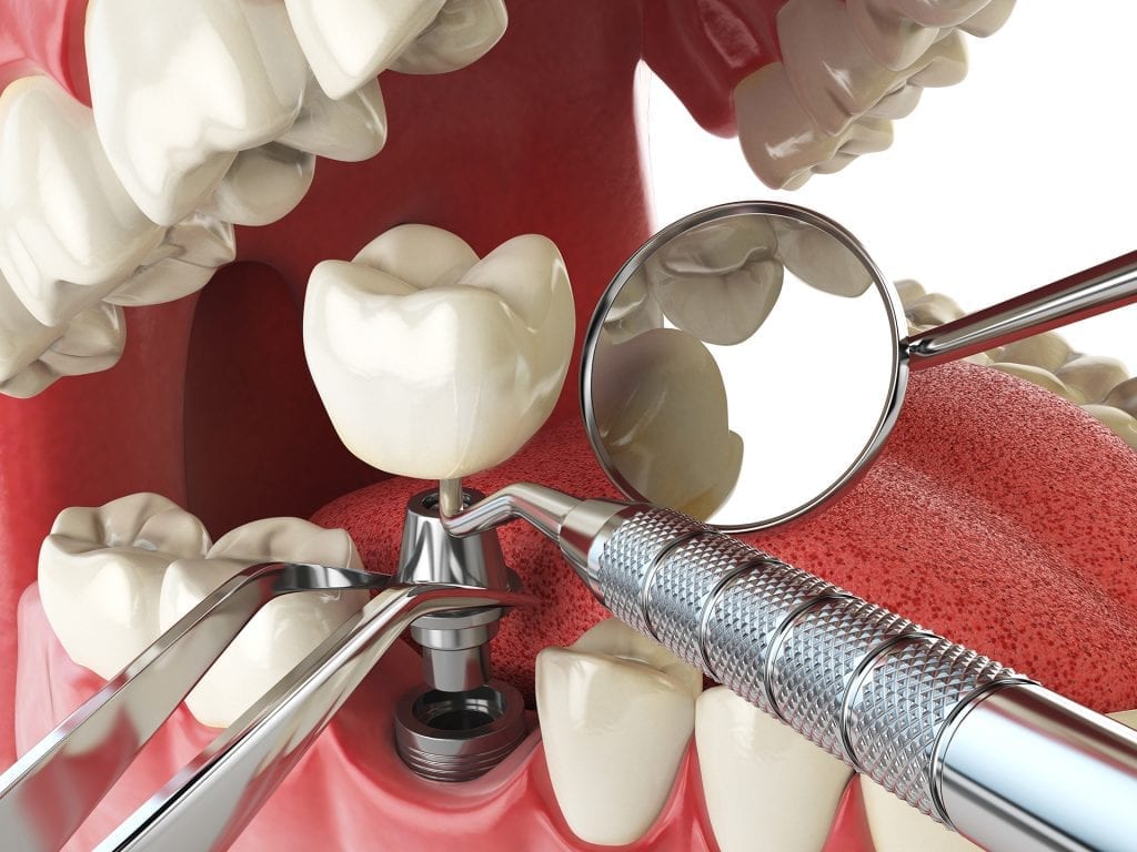 Dental and Denture Care Dental Implants
