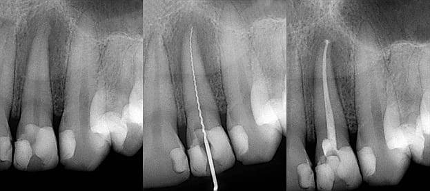 Dental And Denture Care Root Canal