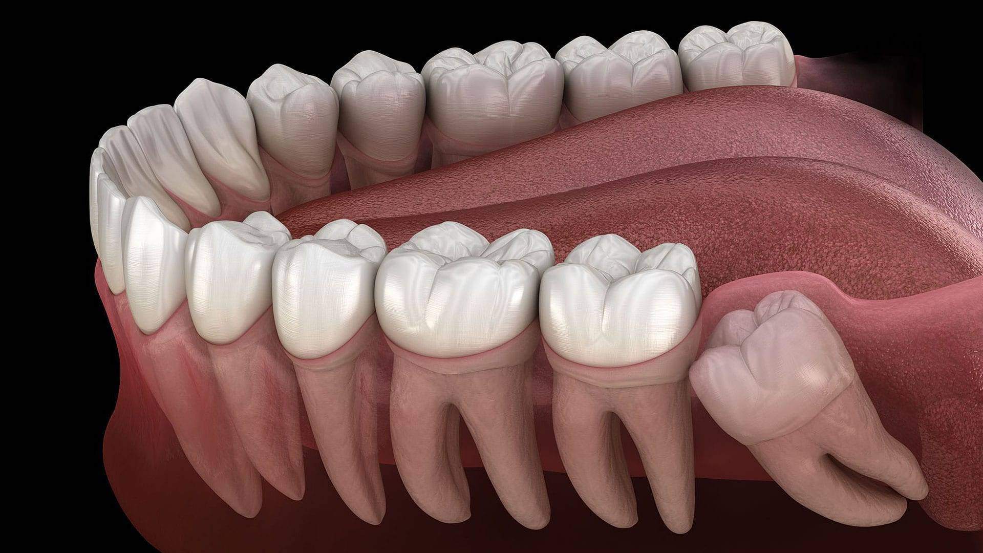 Dental And Denture Care Center Wisdom Teeth Removal