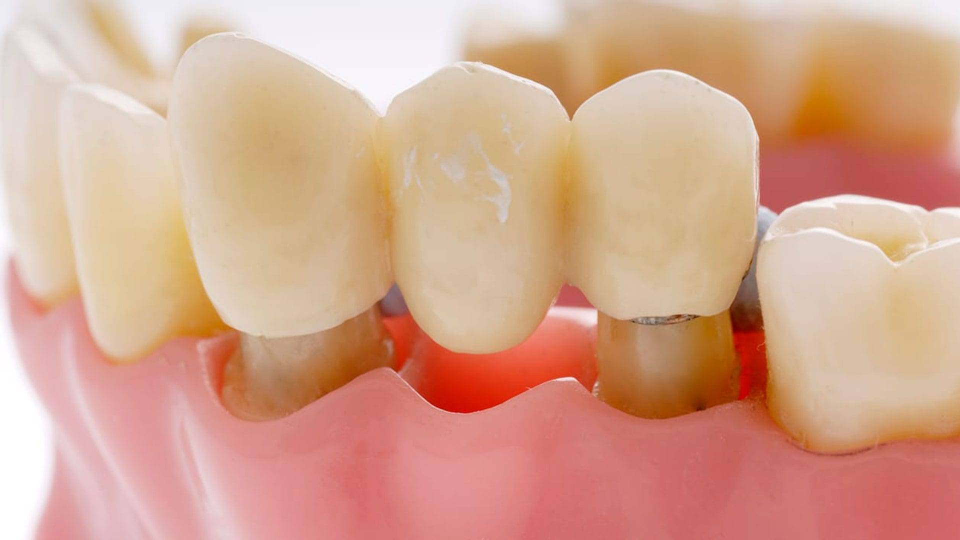 Dental And Denture Care Center Dental Bridges