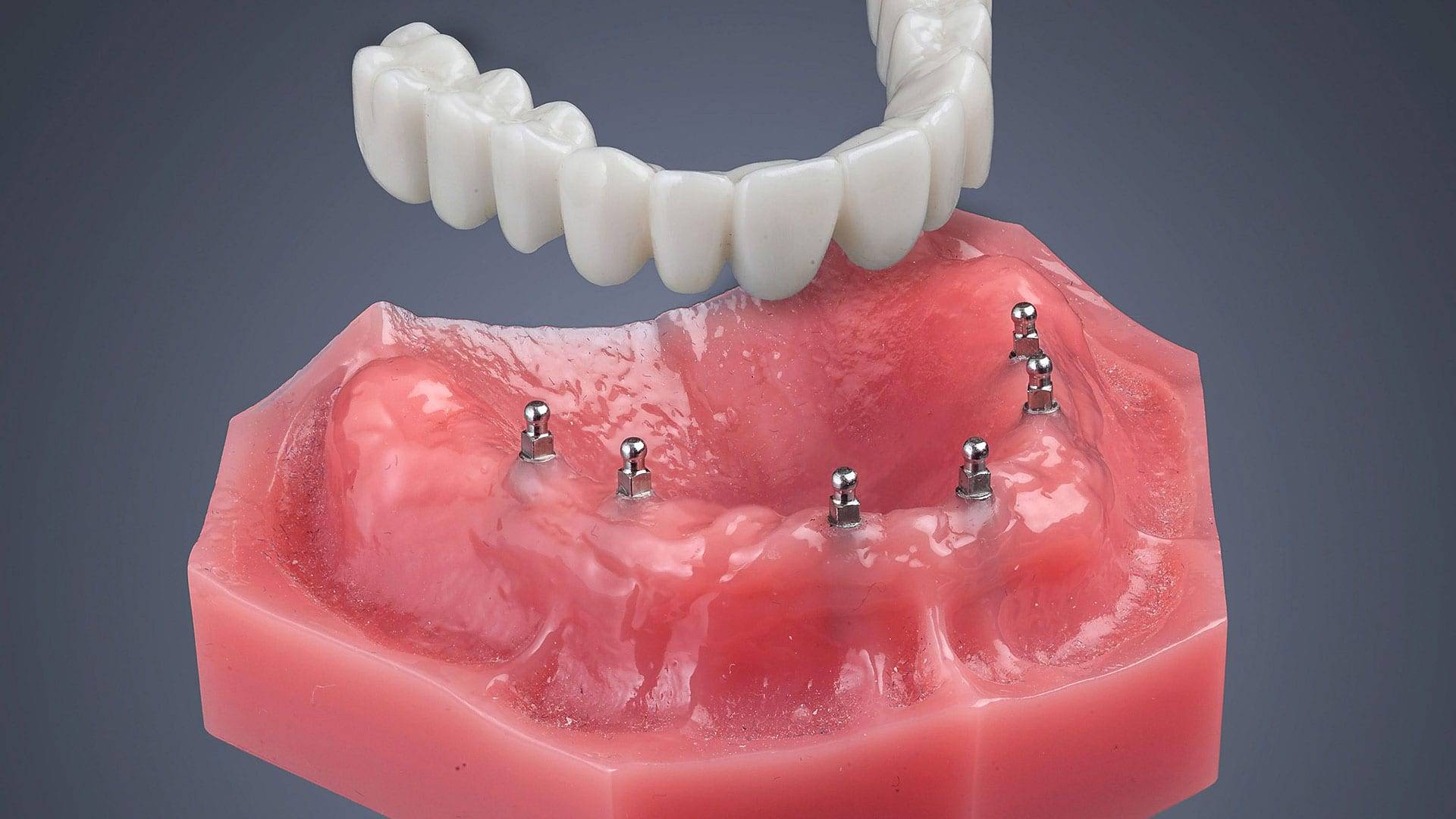 Mini Dental Implants Are Changing The Face Of Dentistry
