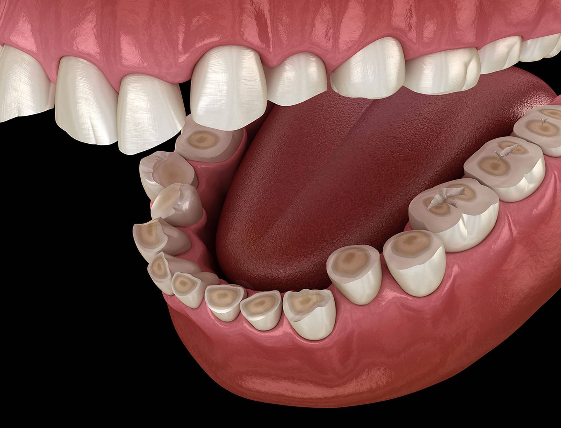 Dental And Denture Care Center Teeth Grinding