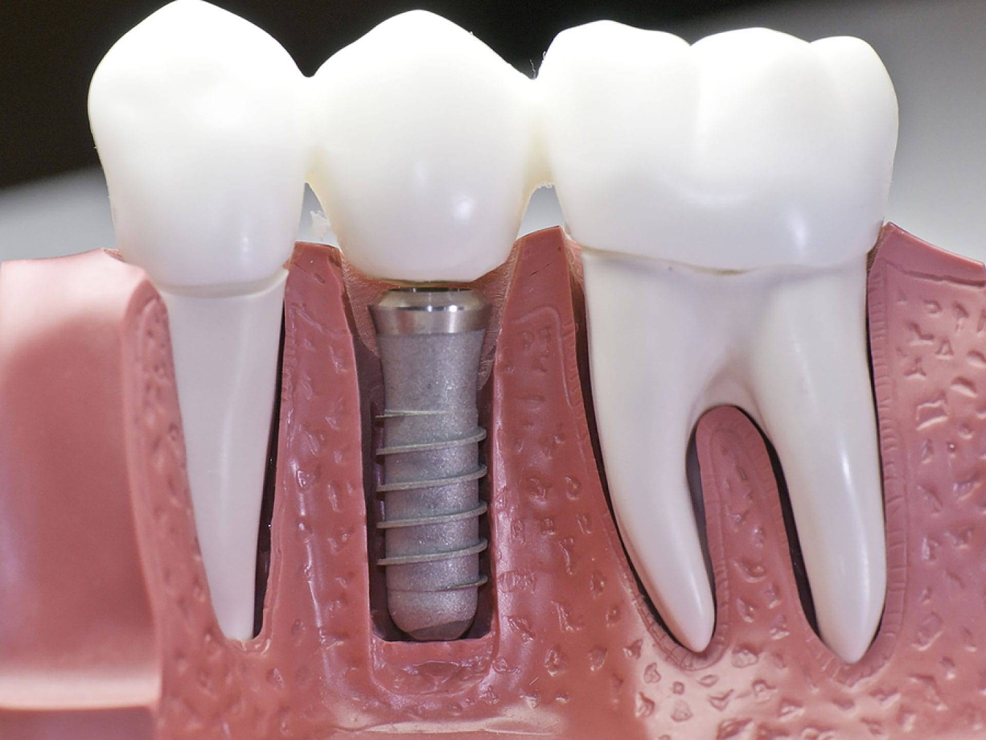 Dental and Denture Care Center Dental Implants Can Change Your Life