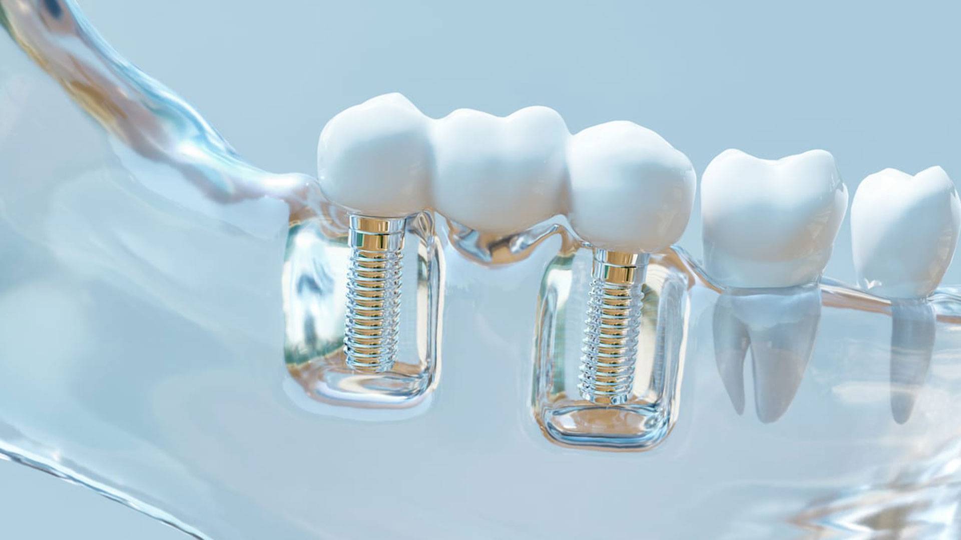 Dental And Denture Care Center, Spring Hill, Dental Crown Implant