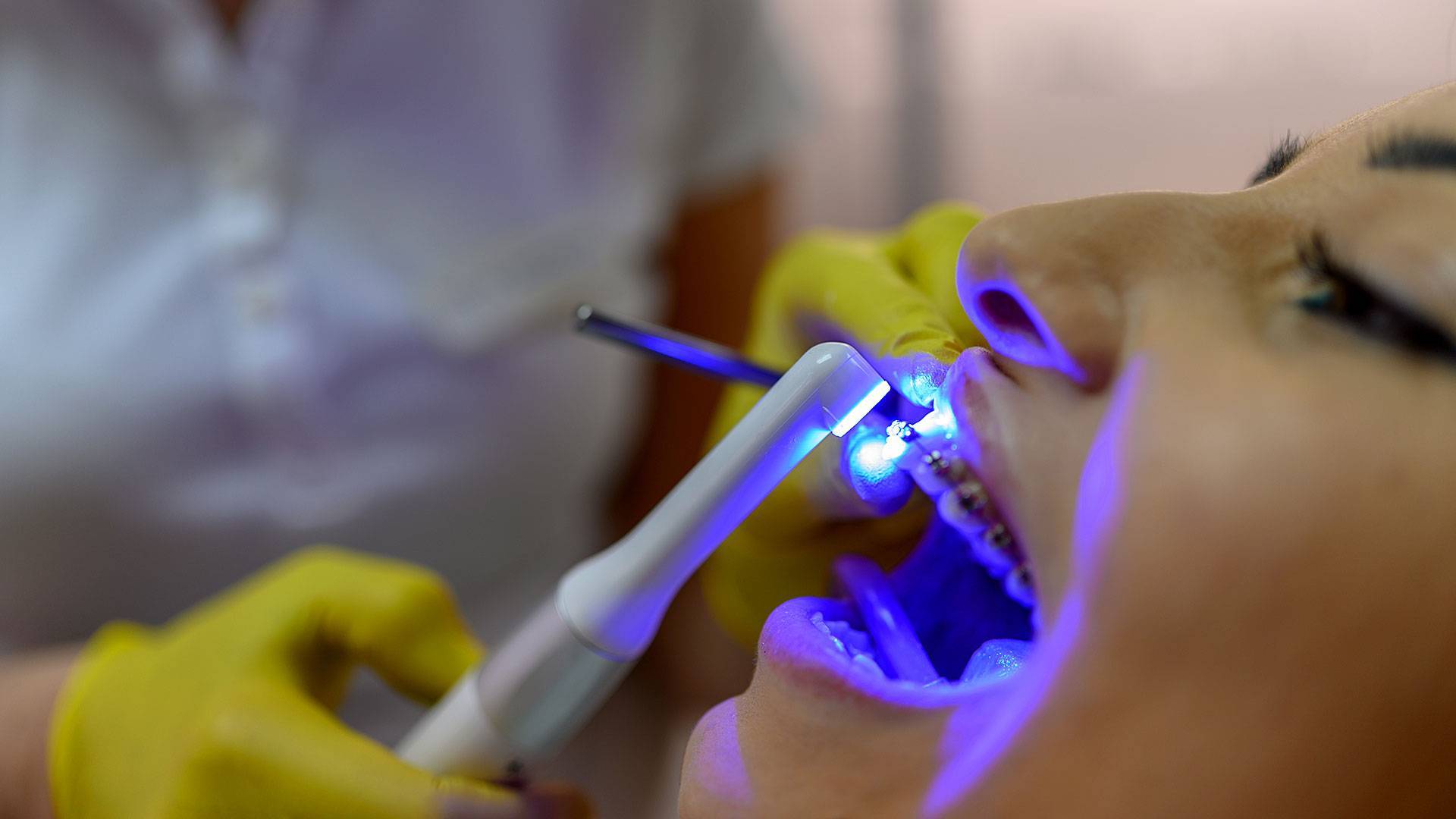How Dental Lasers Are Transforming Oral Hygiene