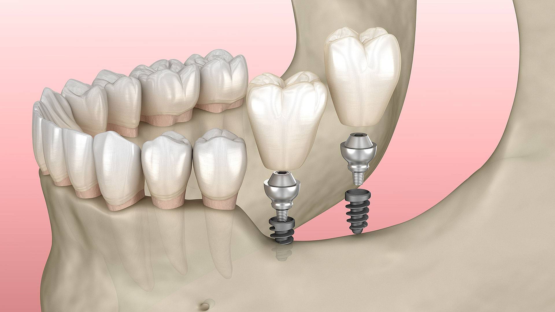 The Dental and Denture Care Center, Spring HIll, FL, Mini Tooth Implants