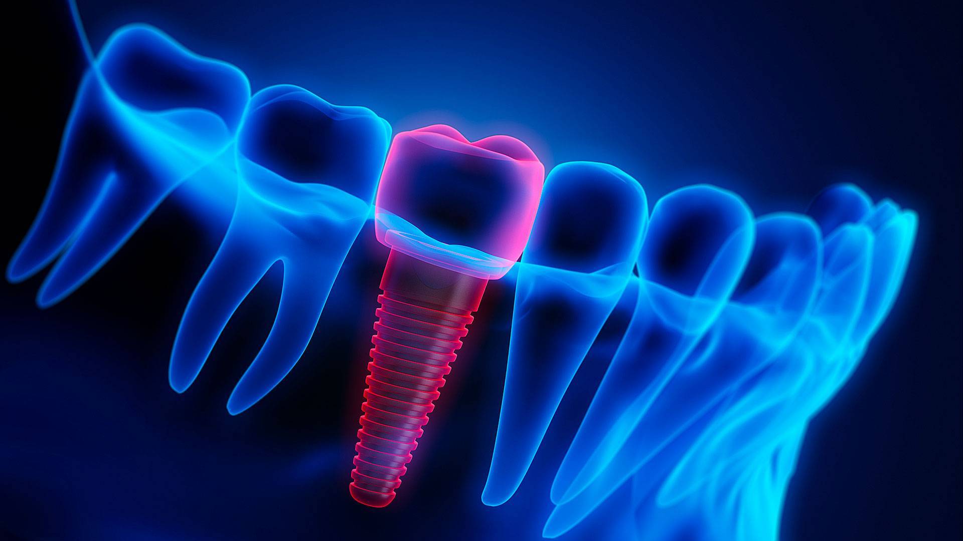 Five Dental Implant Myths