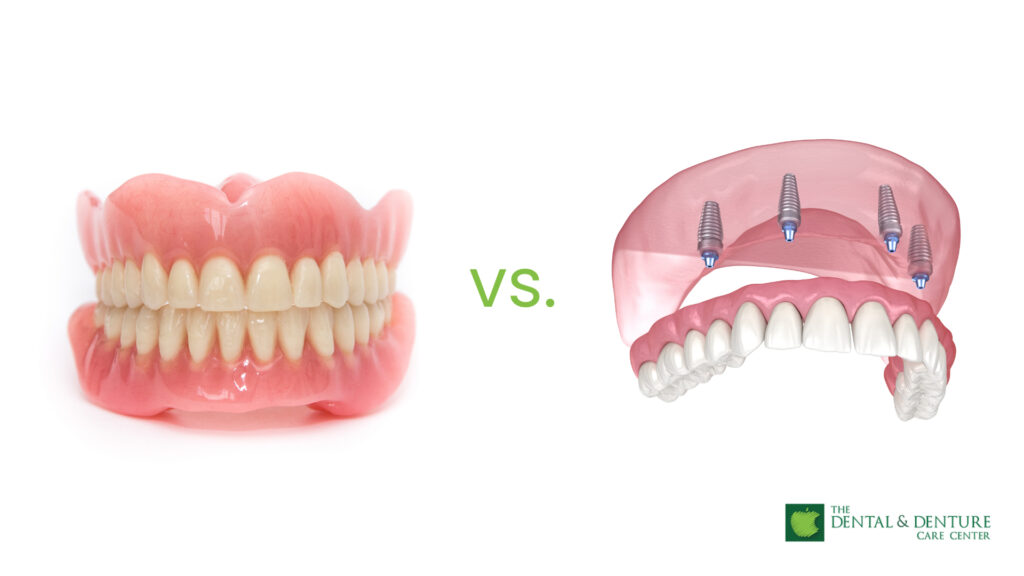 Snap-In Denture vs Conventional Denture