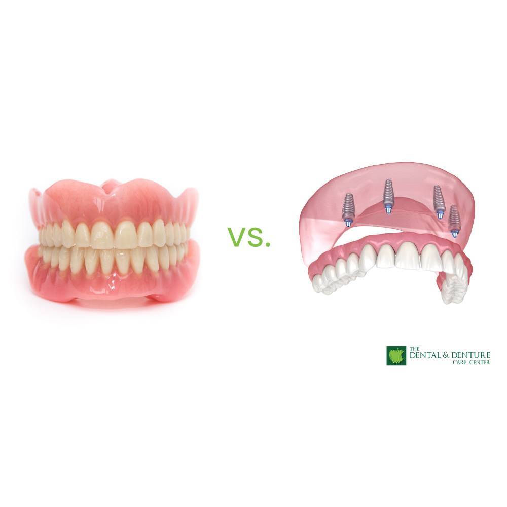 Snap-In Denture vs Regular Denture
