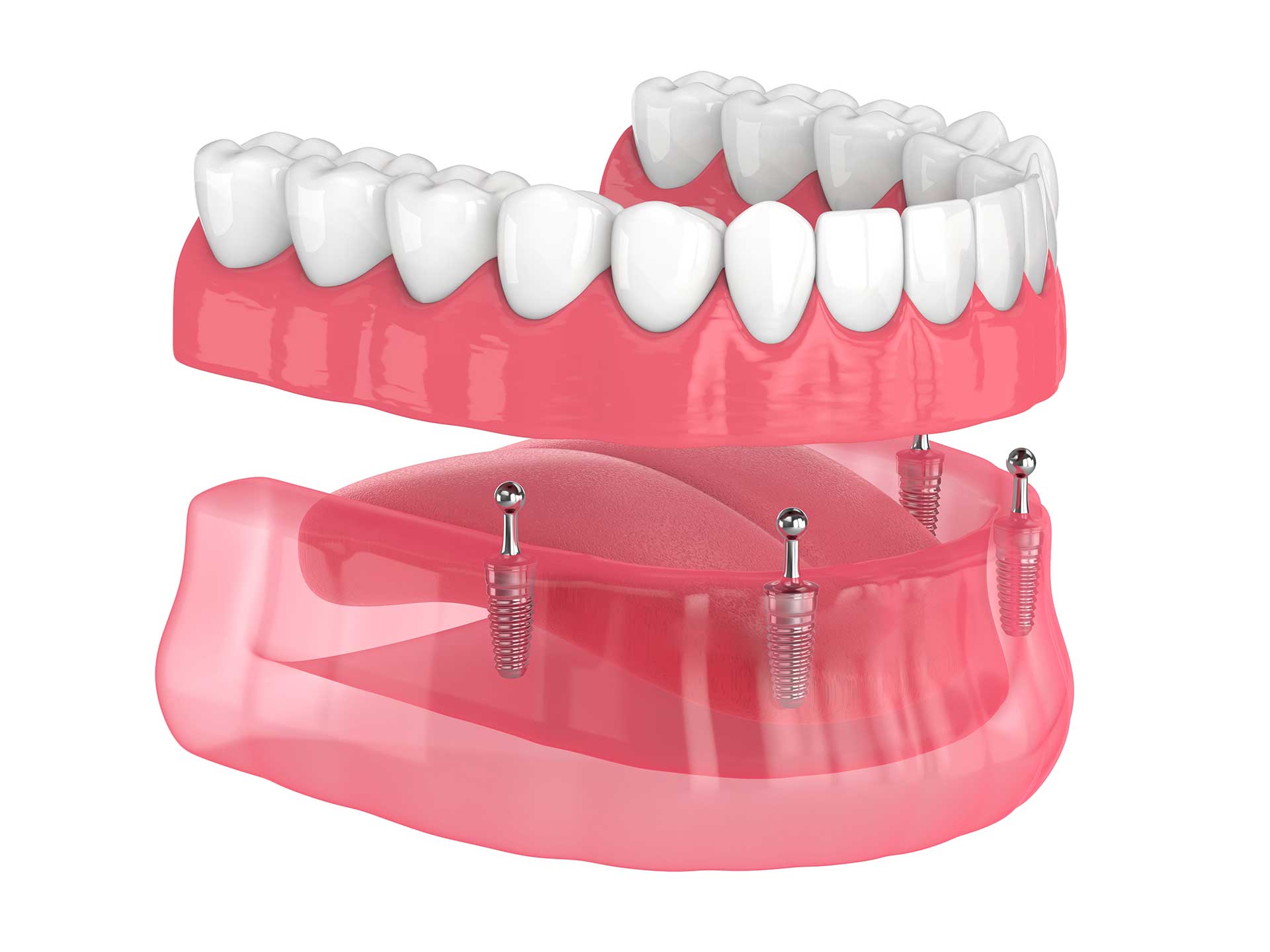 Dental And Denture Care Center, Spring Hill, FL, Implant Supported Hybrid Dentures